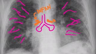 CXR Pneumonias [upl. by Fabrienne789]