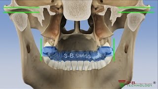 wwwfroehlitherapeuticsch  medizinische Schienentherapie Korrektur Knirscher amp Aufbissschiene [upl. by Aicirtak]