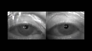 Eye motor abnormalities in Wernicke encephalopathy case 2 [upl. by Graaf]