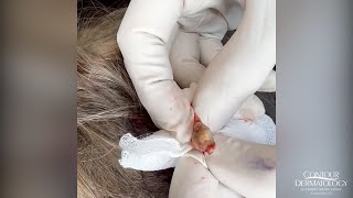 Extracting a Pilar Cyst Pilar Cysts Can Haunt Your Scalp  CONTOUR DERMATOLOGY [upl. by Ogilvy103]