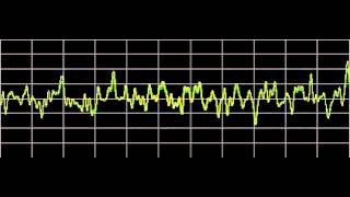 Cluster Headaches  Rife Frequencies [upl. by Avilo]