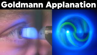 Goldmann Applanation Tonometry Procedure Technique Tutorial [upl. by Iffar]