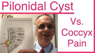 Do you have a PILONIDAL CYST or is it Coccyx Pain Tailbone Pain [upl. by Drew624]