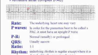 ECG Premature Atrial Complex [upl. by Ardin]