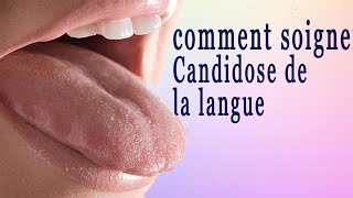 comment traiter Candidoses de la langue [upl. by Ransell]