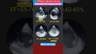 Ejection fraction  Normal EF amp Severe Low EF Short video [upl. by Oman]