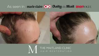 Hair Transplant ResultsThe Maitland Clinic Harley Street Portsmouth [upl. by Nennarb403]