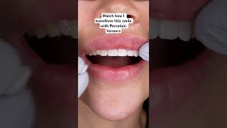 Porcelain veneer smile transformation orthodontist dentaltransformation dentalrestoration [upl. by Zelig]