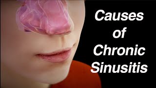 Causes of Chronic Sinusitis Anatomic Factors Biofilm Abnormal Microbiome [upl. by Elwee]