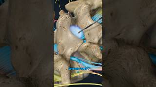 Lumbar Epidural Steroid Injection 3D Animation [upl. by Eliak]