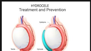 HYDROCELE Treatment amp Nursing Management [upl. by Durand233]