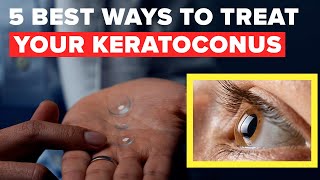 5 Best Ways to Treat Keratoconus Without Surgery [upl. by Aldon474]