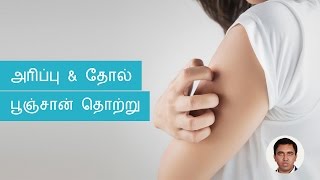 Skin Fungal Infections Symptoms Causes Treatments  Tamil [upl. by Ayokal705]