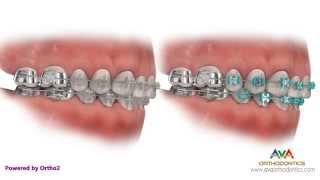 Different Types of Braces Metal Clear or Ceramic Hidden or Lingual [upl. by Caressa]