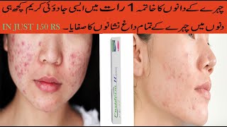 Fusiderm H Cream Review Best Cream To Remove Face Acne For Oily Sensitive Skin acneremovalcream [upl. by Anaitat]