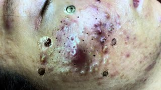 acne and whiteheads on face [upl. by Eladnwahs558]