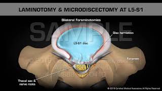 Laminotomy amp Microdiscectomy at L5S1 [upl. by Iredale]