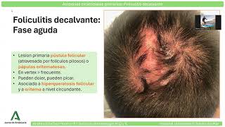 ALOPECIAS CICATRIZALES PRIMARIAS FOLICULITIS DECALVANTE [upl. by Natale]