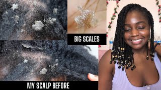 How I cleared Seborrheic Dermatitis amp Healed my scalp NOT SPONSORED  Giveaway [upl. by Tawnya340]