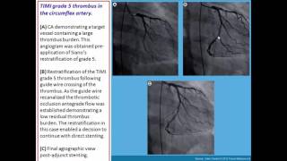 Thrombus containing lesions [upl. by Asnarepse]