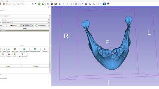 Mandibular osteotomies in orthognathic surgery [upl. by Nedah]