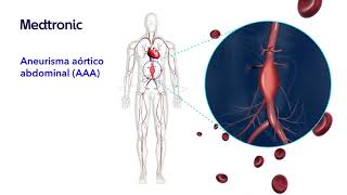 ¿Qué es el aneurisma aórtico abdominal AAA [upl. by Laohcin]