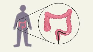 Colorectal cancer screening Arabic [upl. by Romina739]