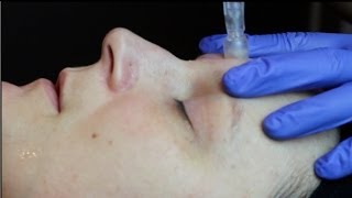 DermaStamp Treatment [upl. by Susanna]