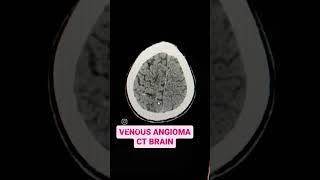 Venous Angioma CT Brain Explained [upl. by Embry]