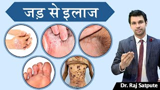 How To Get Rid Of Psoriasis Naturally amp Permanently in One Week by Dr Raj Satpute in Hindi [upl. by Lobell774]