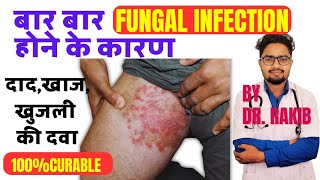 DAD KI SAHI ILAJRING WORM TREATMENTखाज खुजली की दवाFUNGAL INFECTION TREATMENTTINEADRRAKIB [upl. by Hilliary]