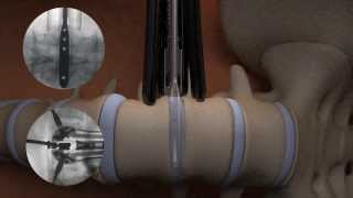 TIMBERLINE® Lateral Fusion System  Surgical Animation [upl. by Roanne599]