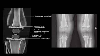 SCURVY VS RICKETS RADIOLOGY [upl. by Angela]