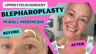 Is BALI the place for EYELID surgery My story The first 8 days [upl. by Niatsirt337]