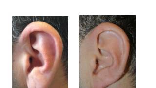 Earlobe reduction surgery [upl. by Dorin]