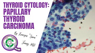 Thyroid Cytology Papillary Thyroid Carcinoma [upl. by Moorish750]