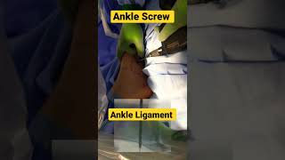 Ankle Syndesmotic Ligament Screw Fixation ✓✓ ankleanatomy sprainedankle ligament ligamentinjury [upl. by Kohcztiy]