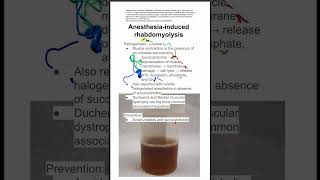 Anesthesiainduced rhabdomyolysis [upl. by Caruso]