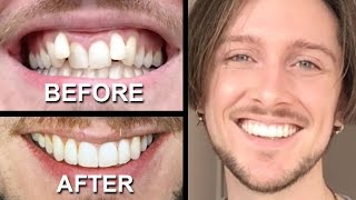 INVISALIGN REVIEW  everything you need to know [upl. by Nylecoj550]