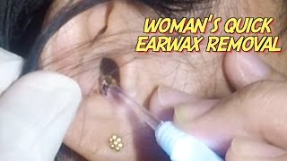 Womans Quick Earwax Removal [upl. by Ecnerrat451]