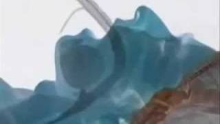 Laryngeal Mask Airway Insertion [upl. by Aehs]