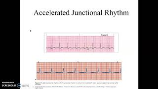 Accelerated Junctional and Junctional Tachycardia [upl. by Anead552]