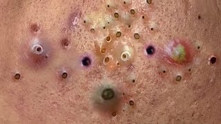 blackheads new 2023  popping pimple  acne and whiteheads removal [upl. by Enileuqcaj]