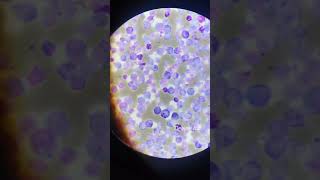 Marrow cells present CML microscope reels medicallabviralvideo [upl. by Shane513]