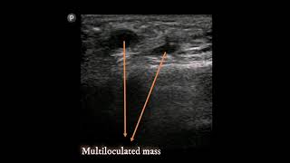 Permanent Filler  UltrasoundGuided injection of intralesional steriod [upl. by Winston]