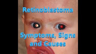 Retinoblastoma  Symptoms Signs and Causes [upl. by Medea418]