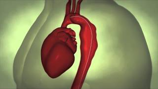 Thoracic Aortic Aneurysm [upl. by Avictor]