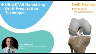 UltraSTAR Hamstring Graft Prep Technique w ULTRABUTTON Adjust Fix Device amp XWING Graft Prep System [upl. by Ennaus]