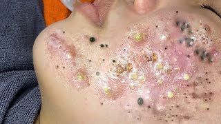 Big Cystic Acne Blackheads Extraction Blackheads amp Milia Whiteheads Removal Pimple Popping  9278 [upl. by Necila686]