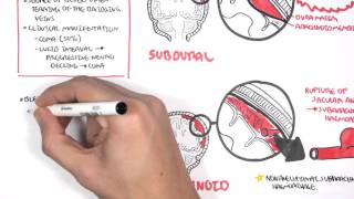 Intracranial Haemorrhage Types signs and symptoms [upl. by Myna586]